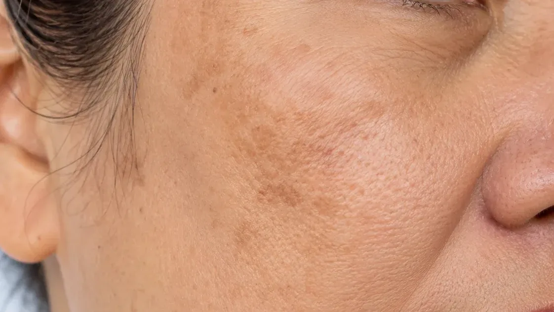 Age Spots & Sun Damage — condition