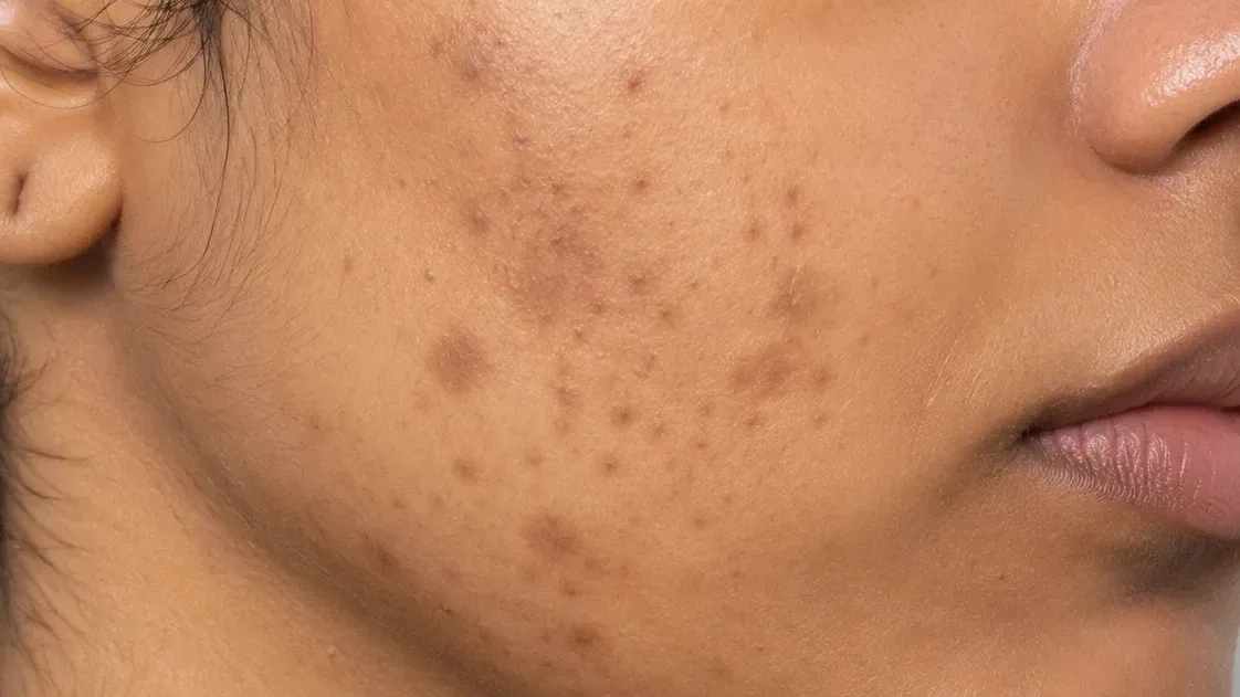 Post-Inflammatory Hyperpigmentation — condition