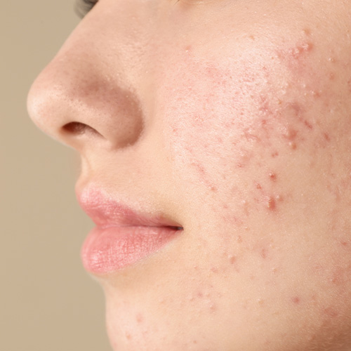 Active Acne — in clinic