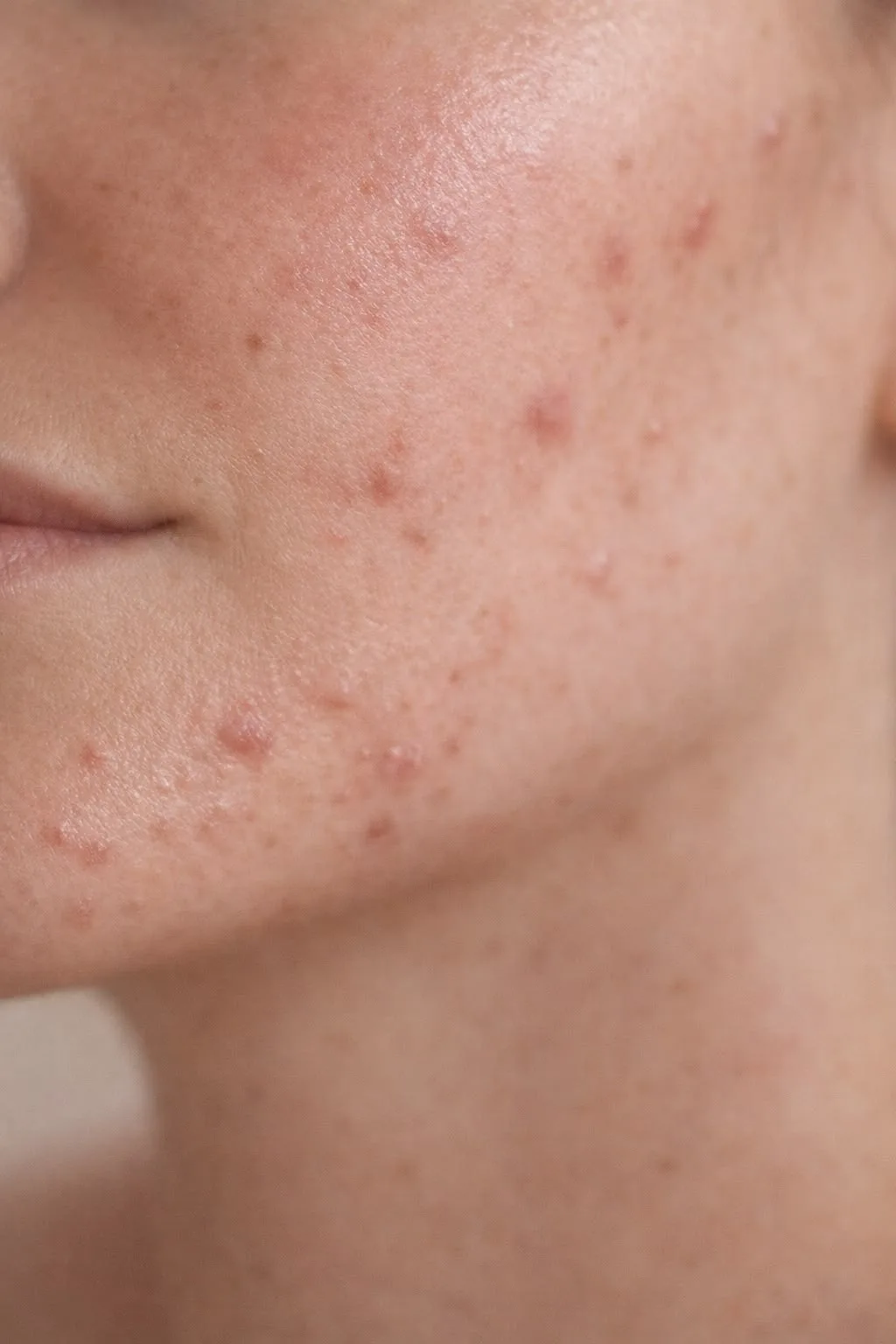 Active Acne — condition