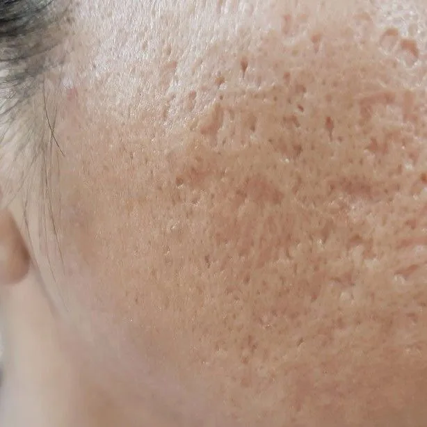Acne Scars — condition