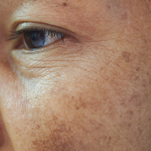 Age Spots & Sun Damage — in clinic