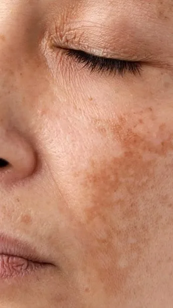 Melasma & Hyperpigmentation — in clinic
