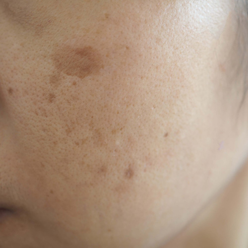 Melasma & Hyperpigmentation — condition