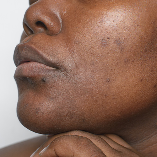 Post-Inflammatory Hyperpigmentation — in clinic