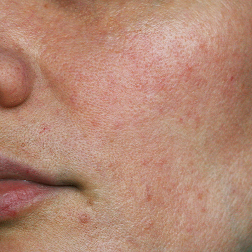Redness & Rosacea — in clinic