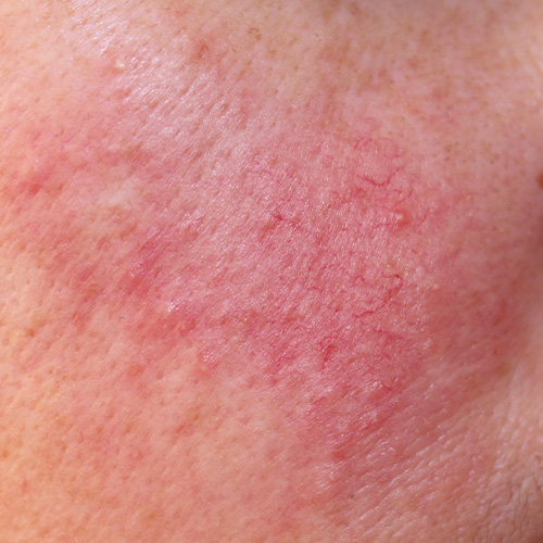 Redness & Rosacea — condition