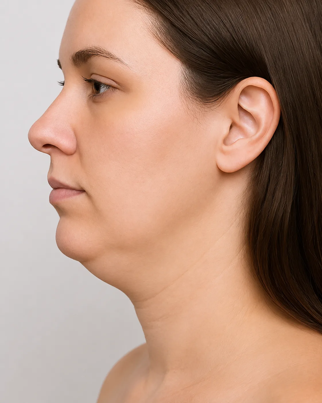 Double Chin — condition