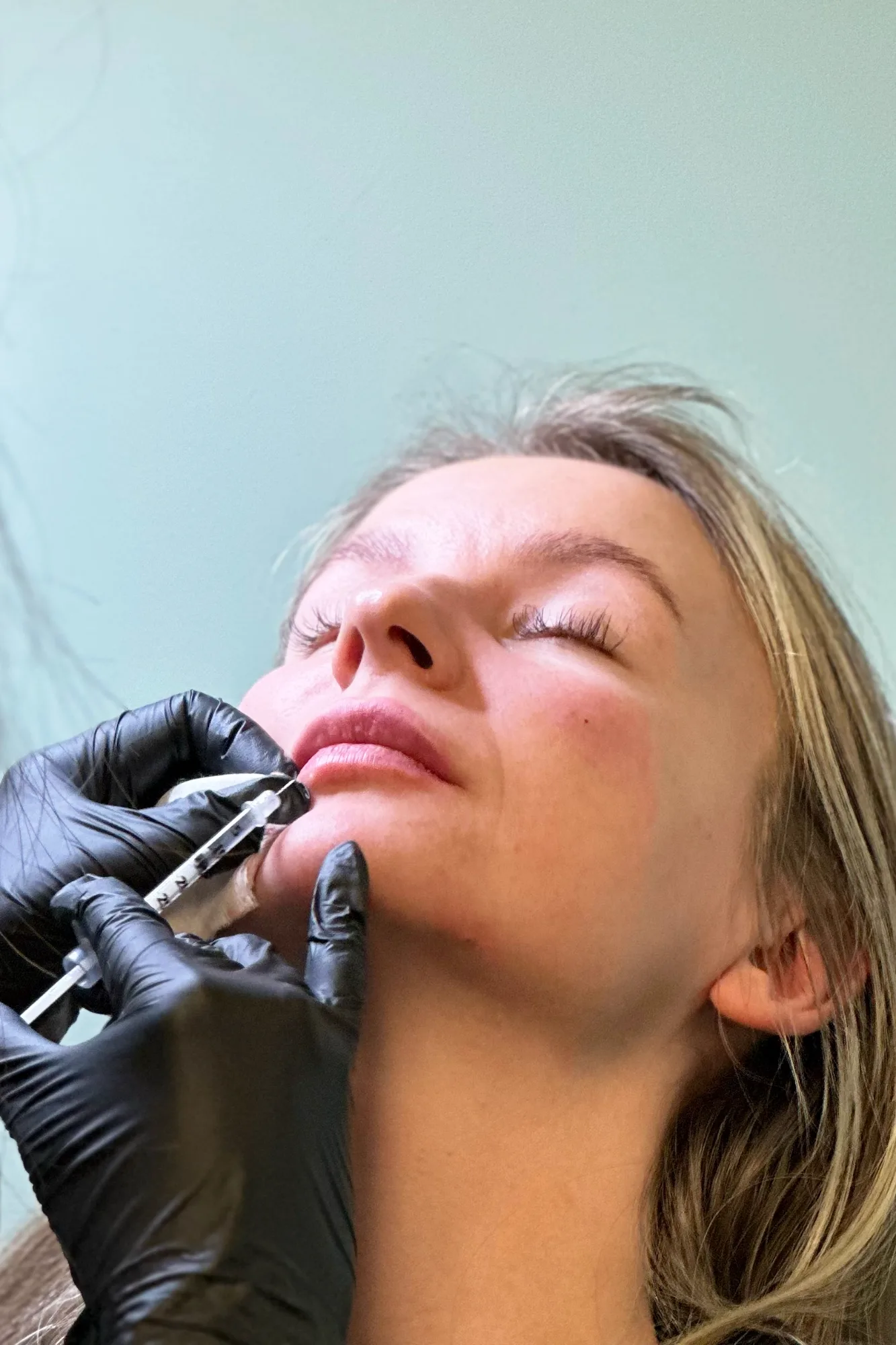 Dermal Fillers — treatment