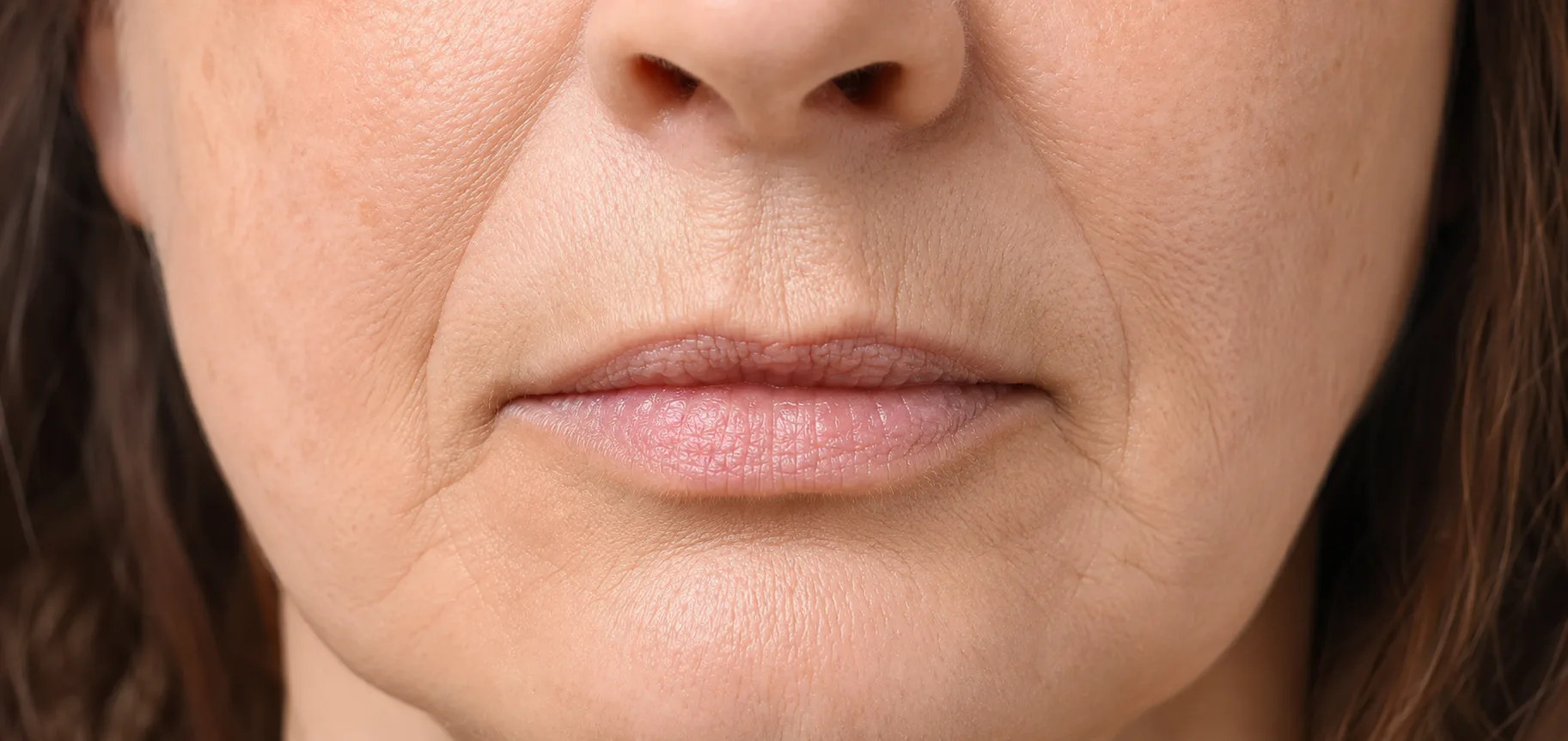 Lip Lines & Volume Loss