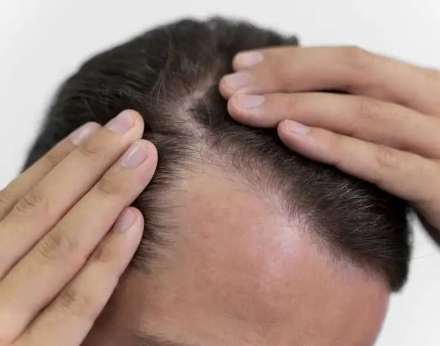 Hair Restoration