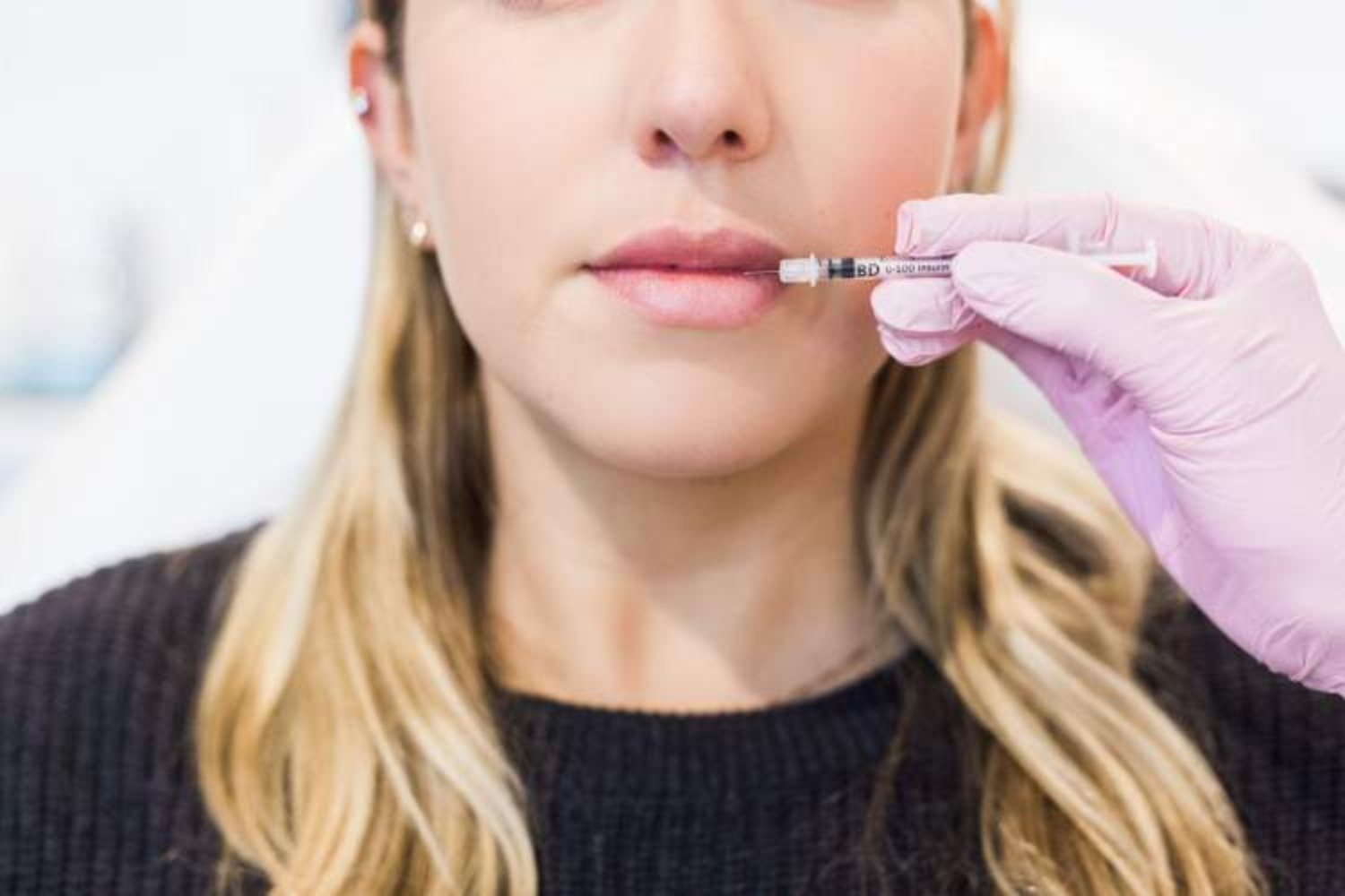 Lip Filler — treatment
