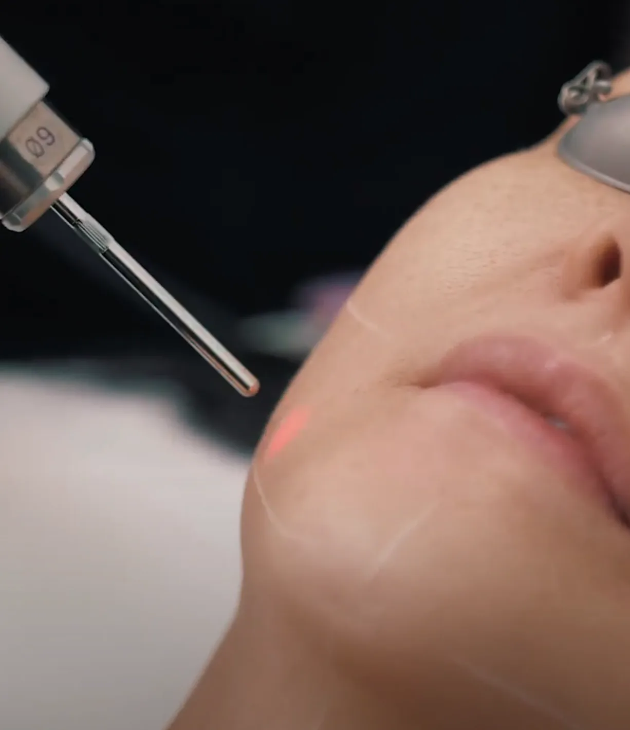 Reset Laser Treatment — treatment