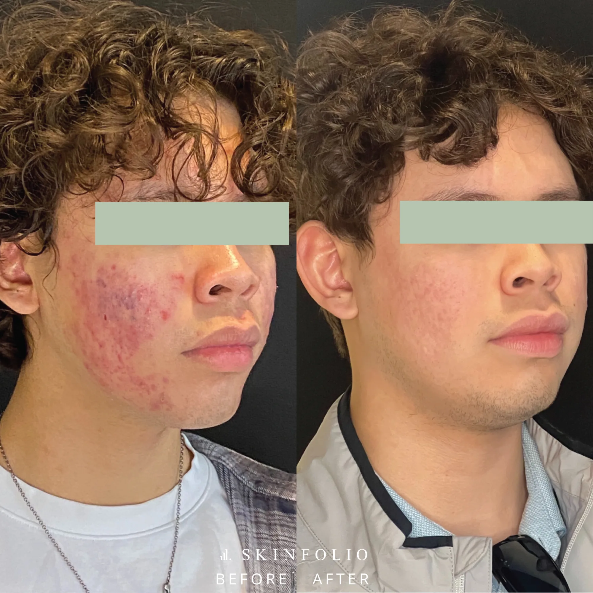 Acne
