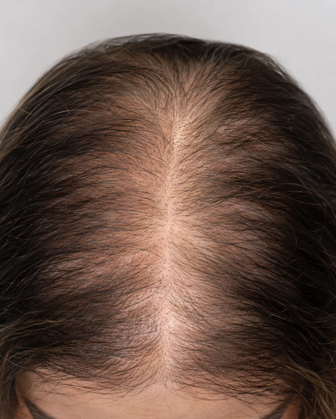Weakened or miniaturized follicles