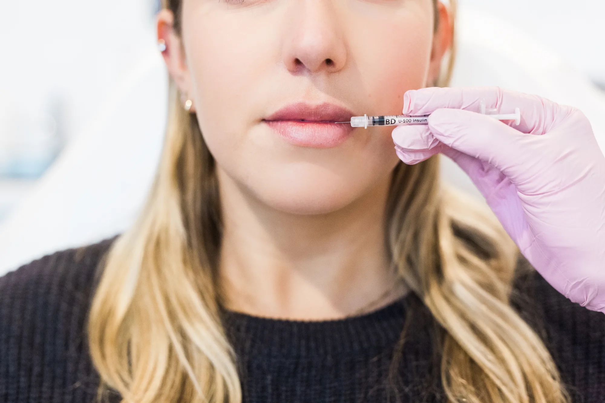 Lip Filler — treatment