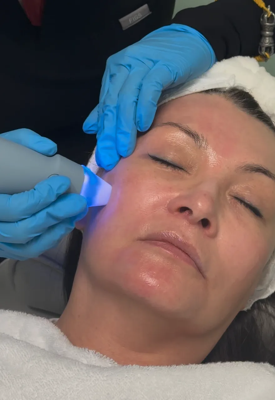 RF Microneedling — treatment