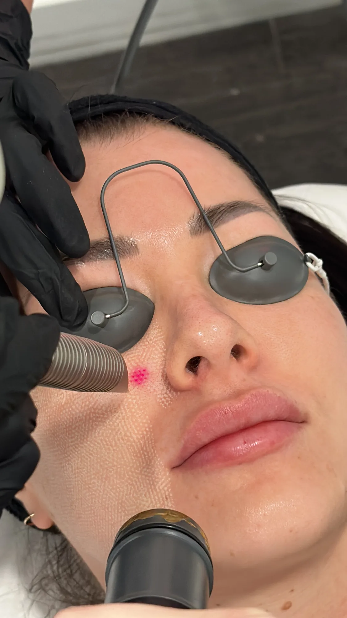 Laser — in clinic