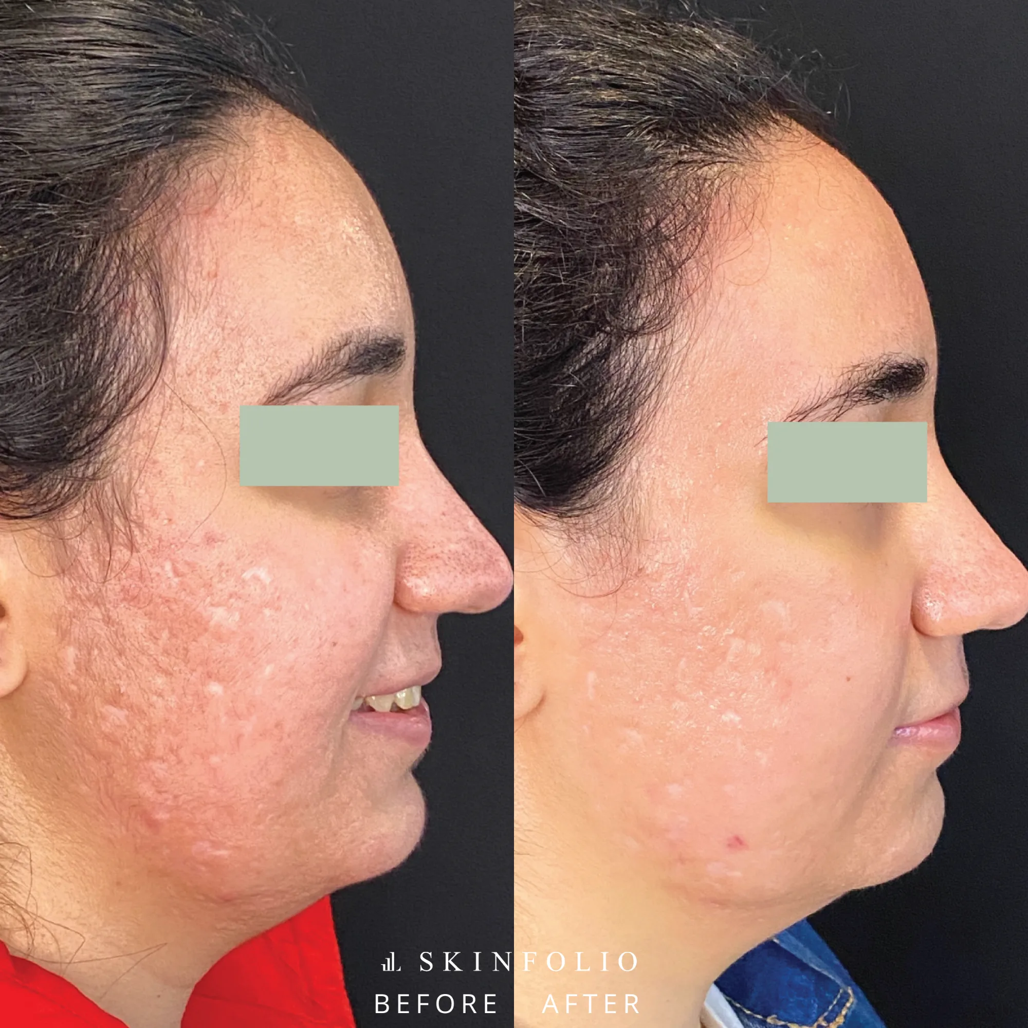 Before and after result