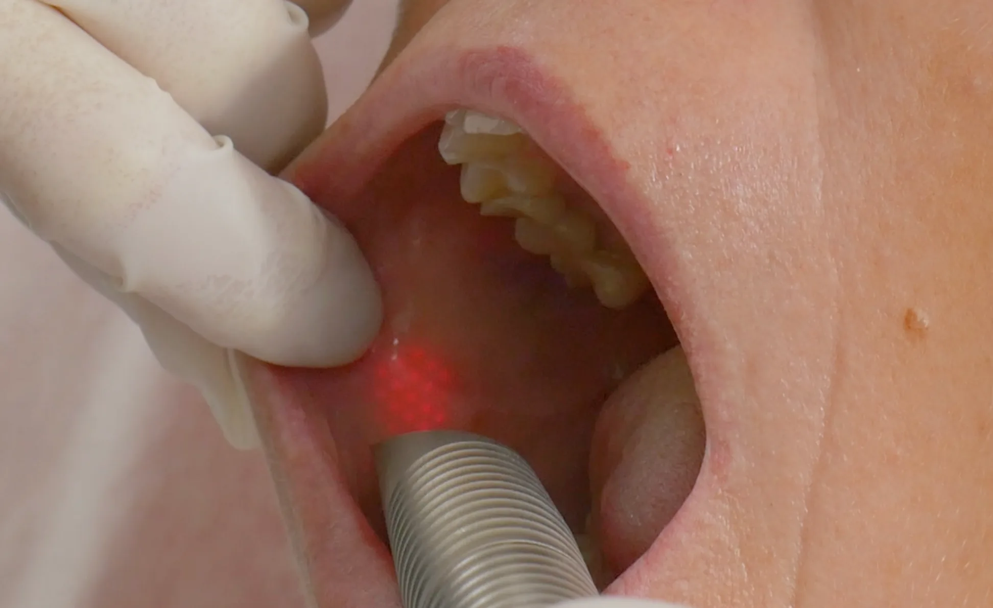 LipLase — treatment