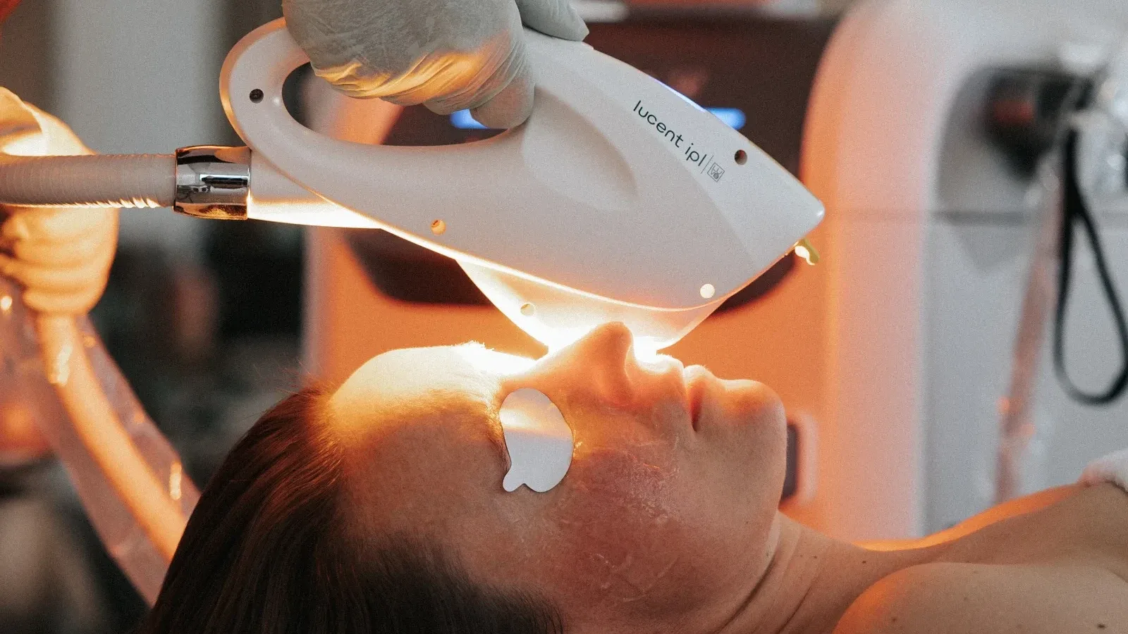 IPL Photofacial — treatment