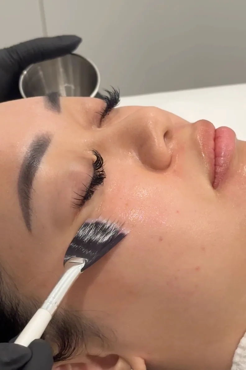 MandeliClear Peel — treatment