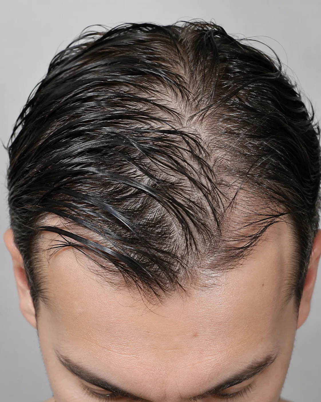 Oily or greasy scalp