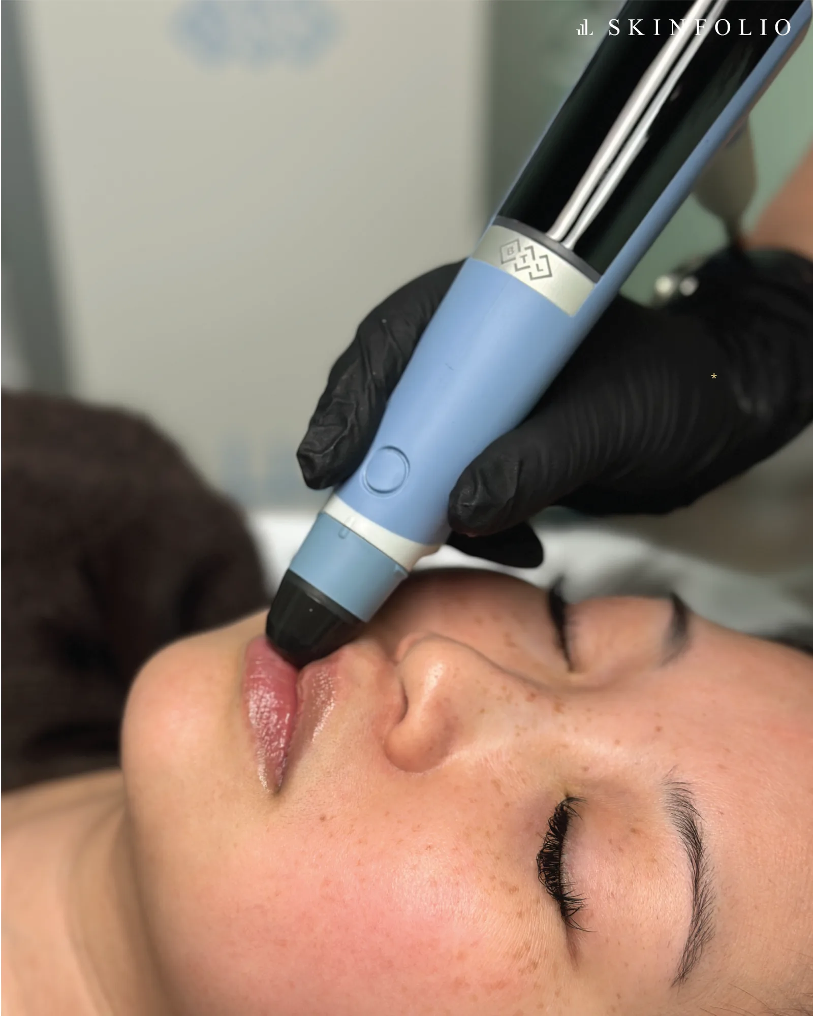 RF Collagen Stimulation — treatment
