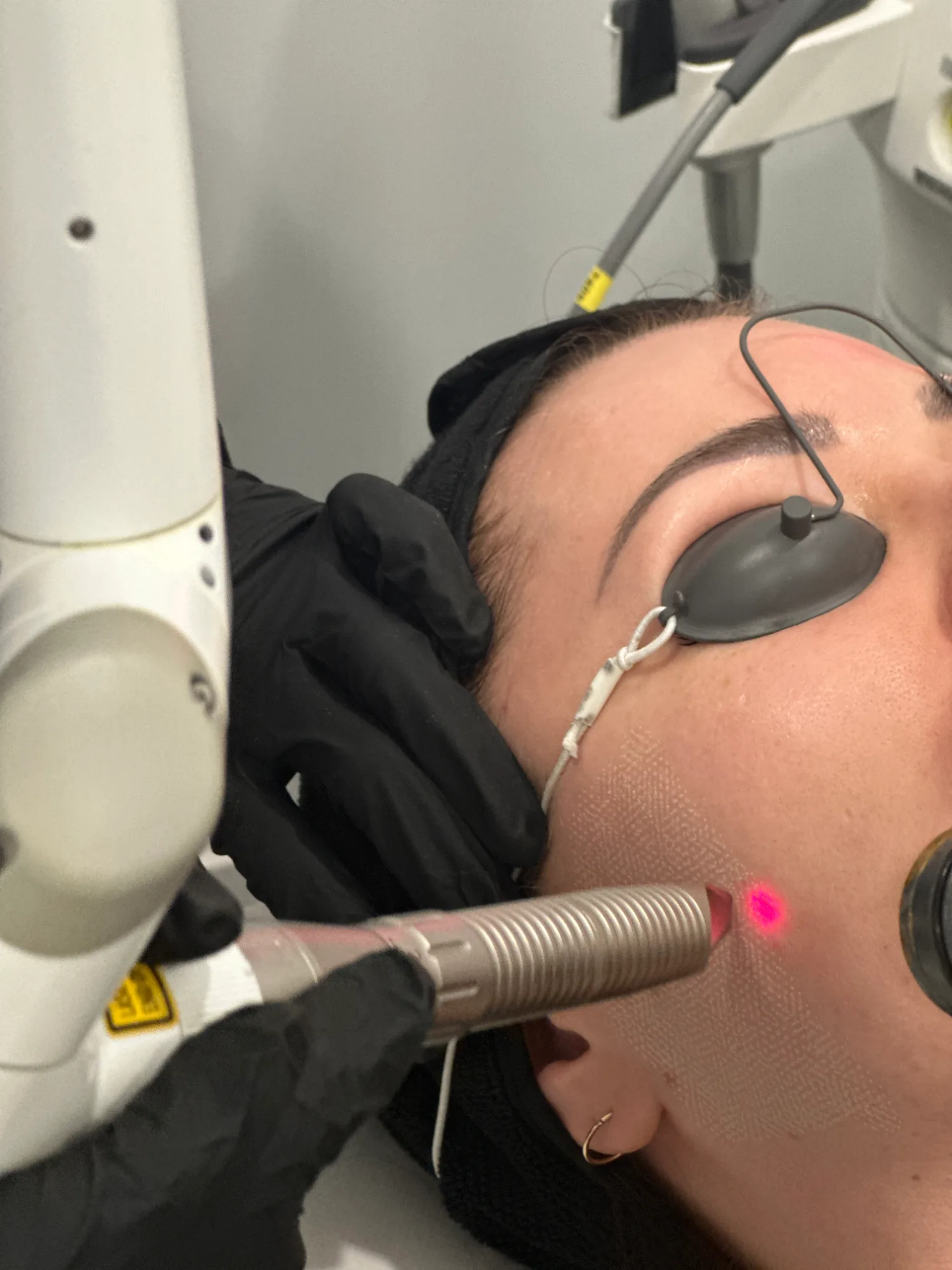 Reface Laser Treatment — treatment