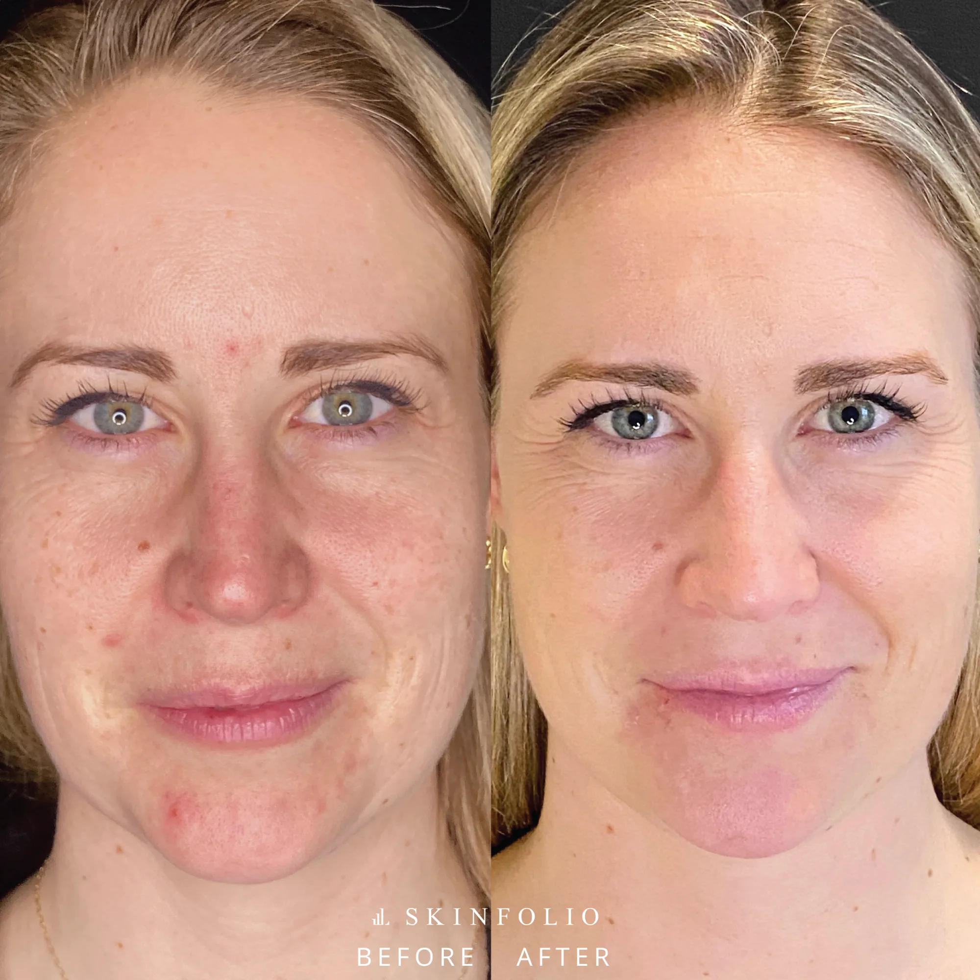 Before and after result