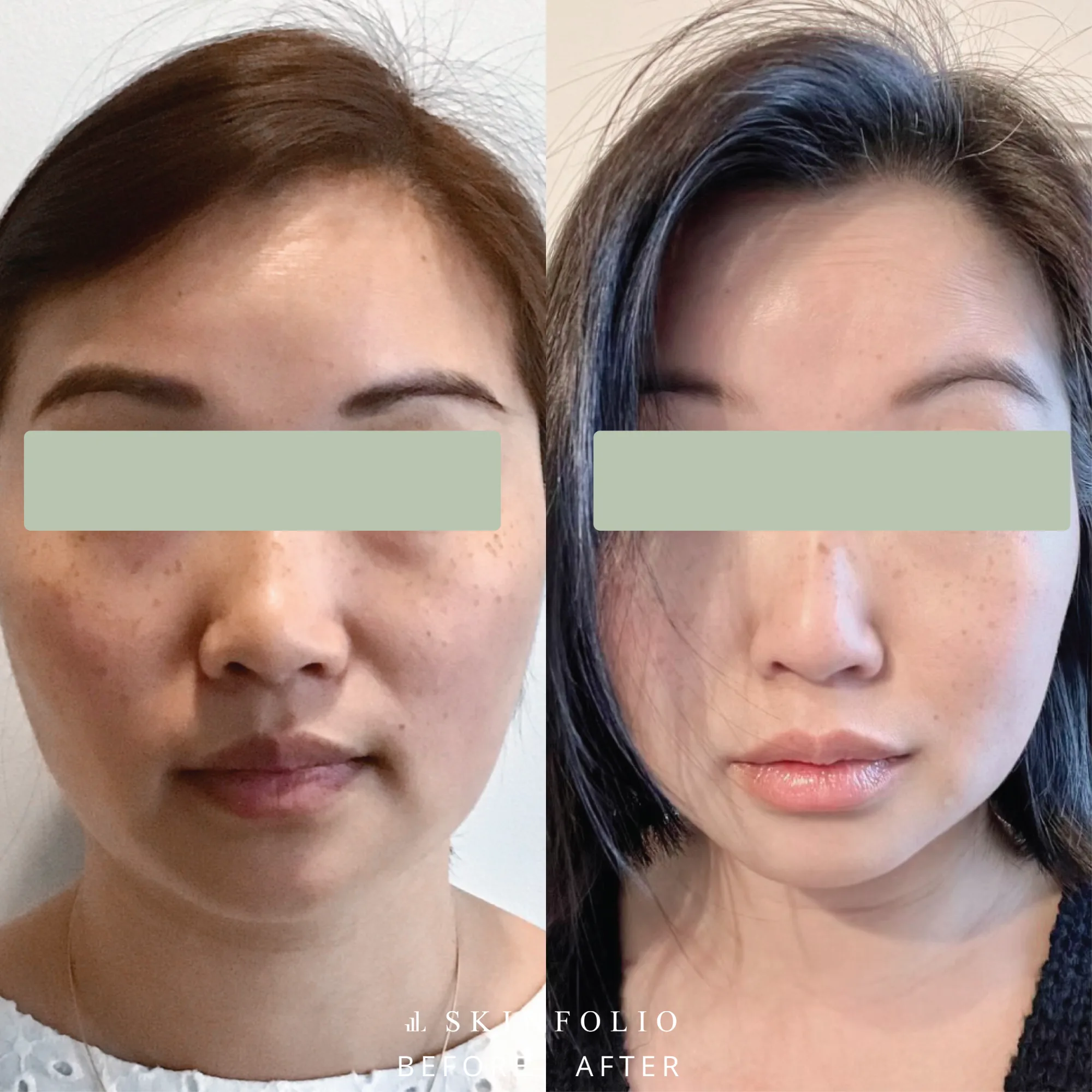 Before and after result