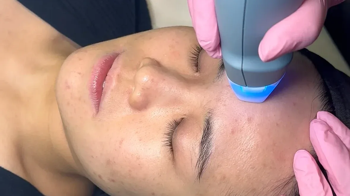 EXION Clear RF — treatment