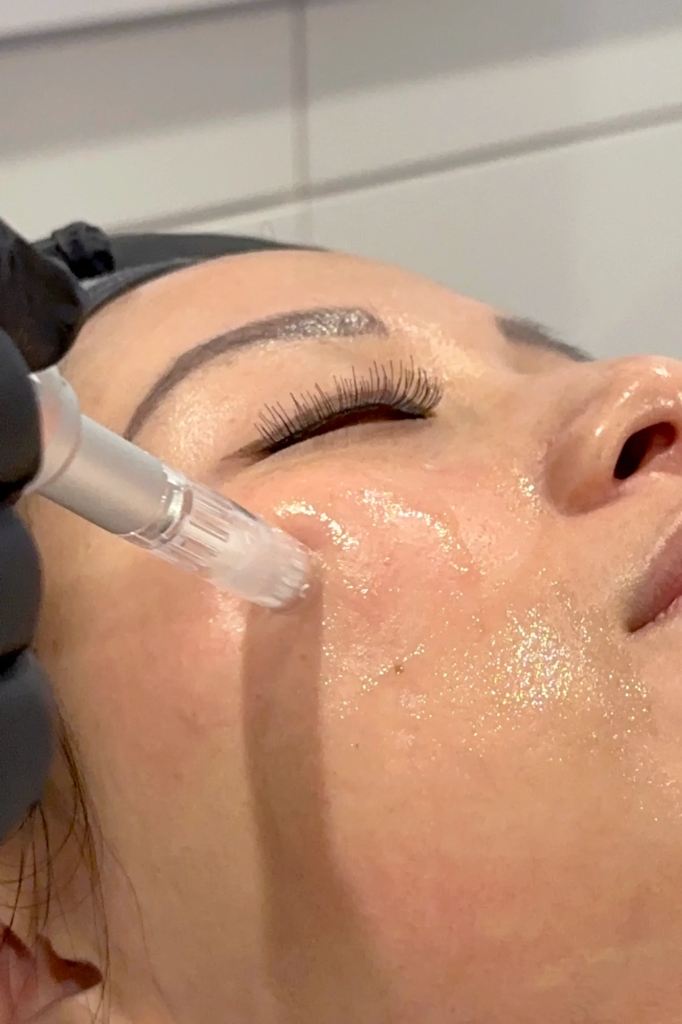 Collagen & Lifting — in clinic