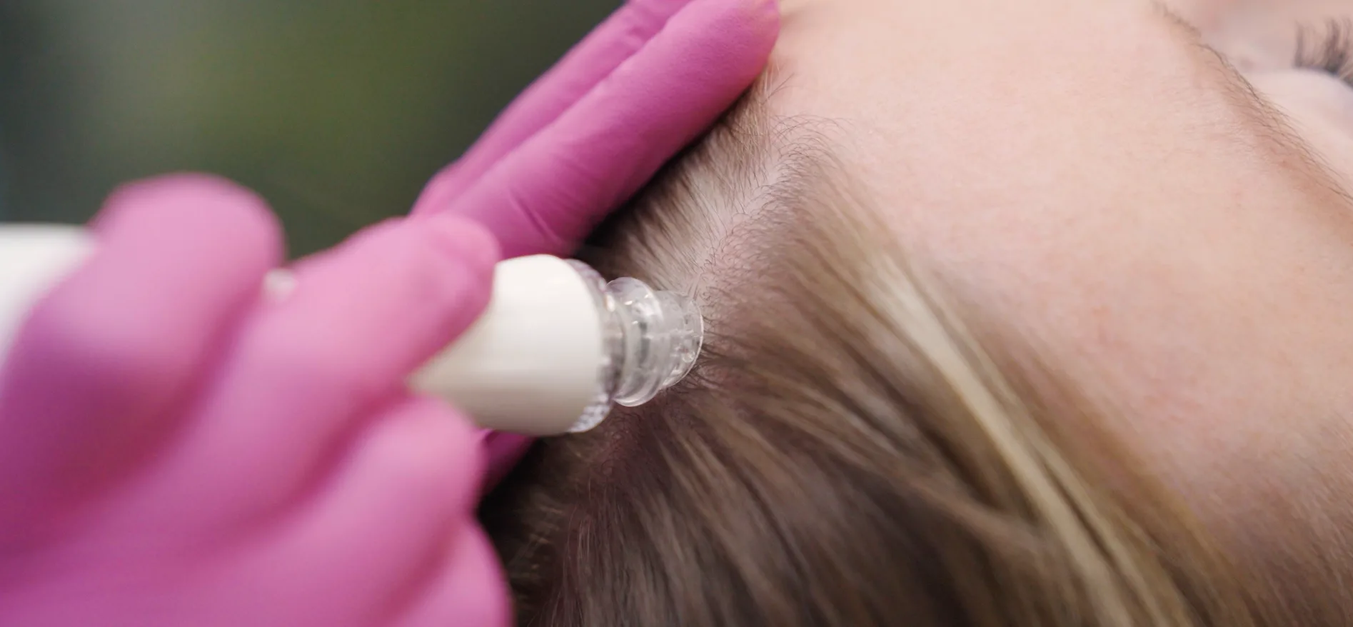 Hair Follicle Treatment — treatment
