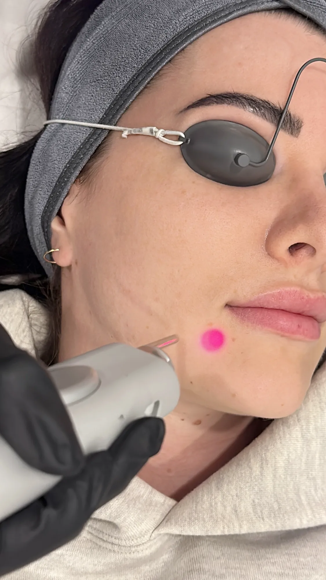 Laser — in clinic