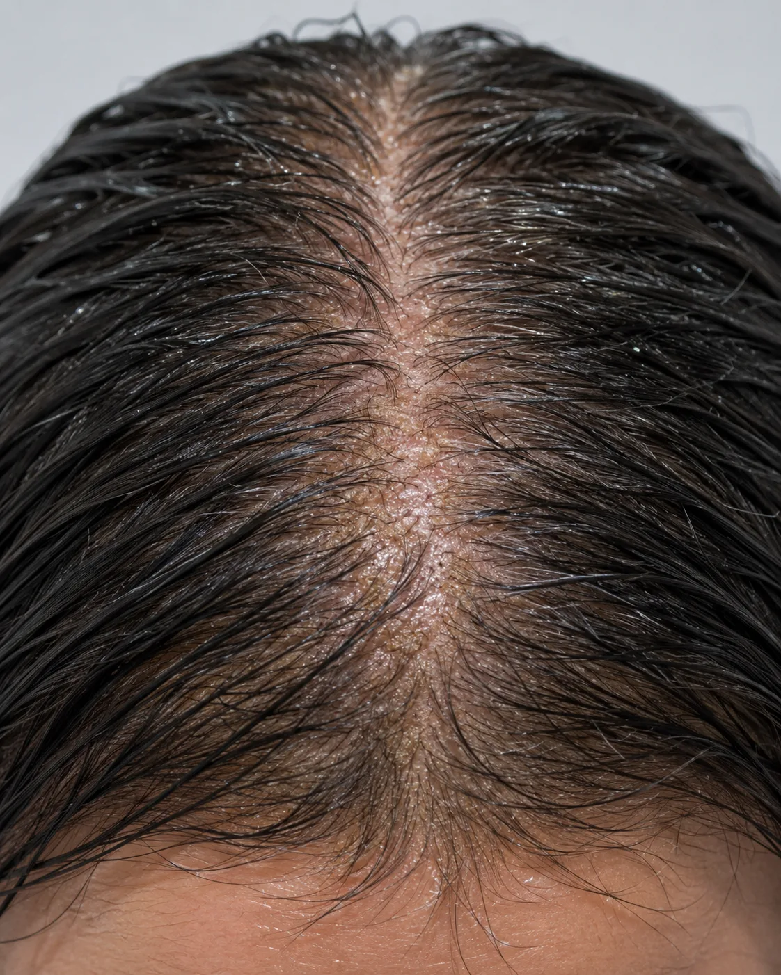 Scalp congestion