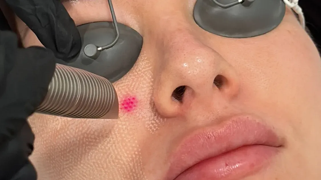 Reface Laser Treatment — treatment