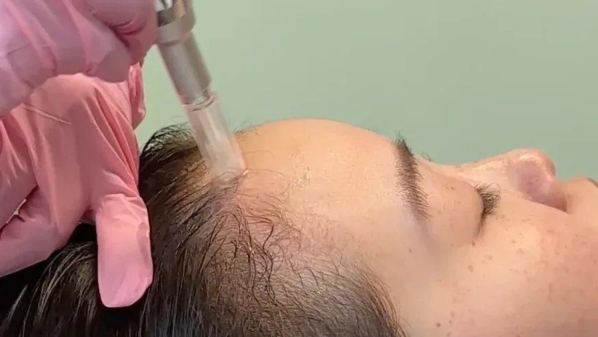 Hair Microneedling — treatment