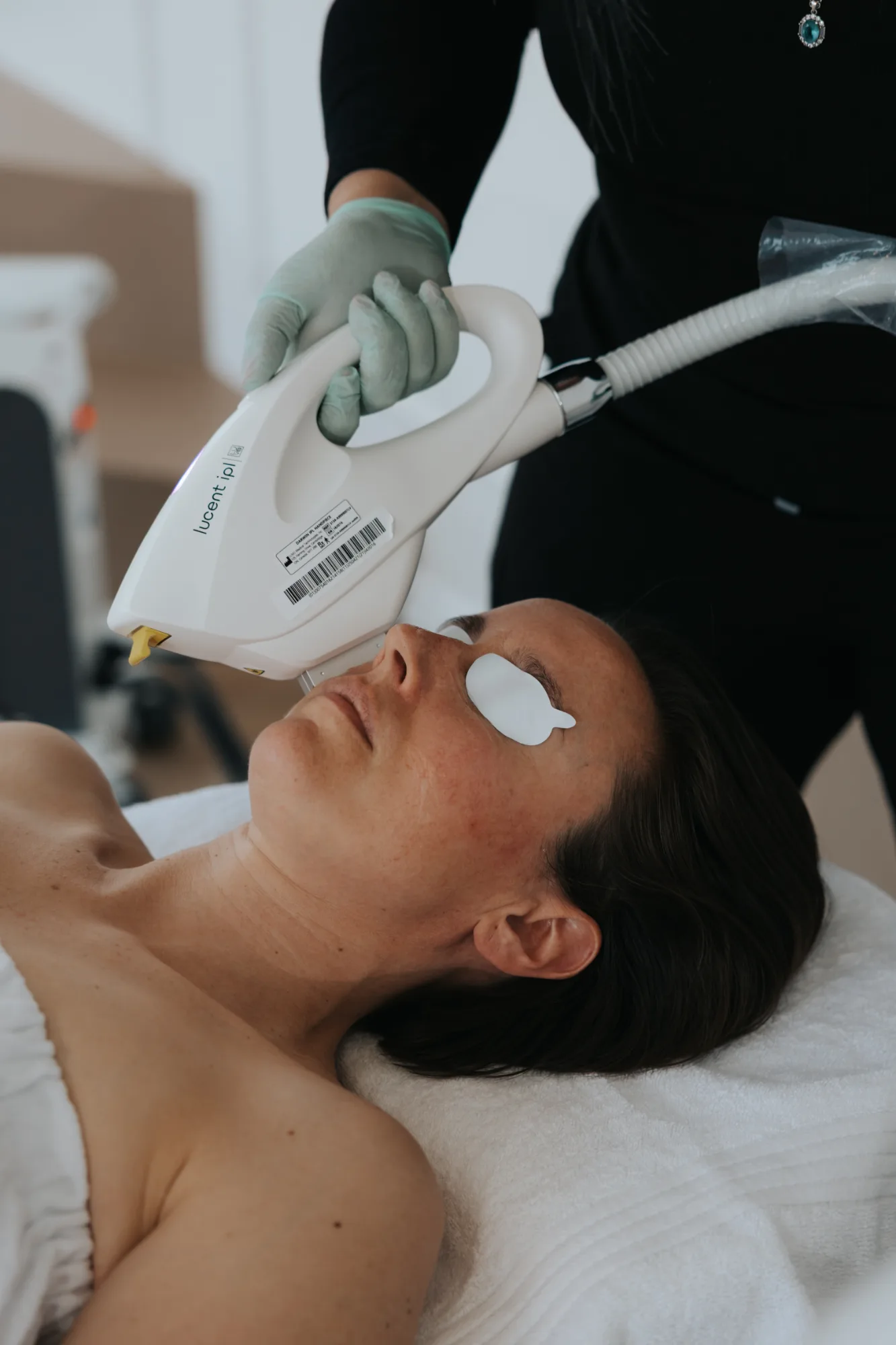 IPL Photofacial — treatment