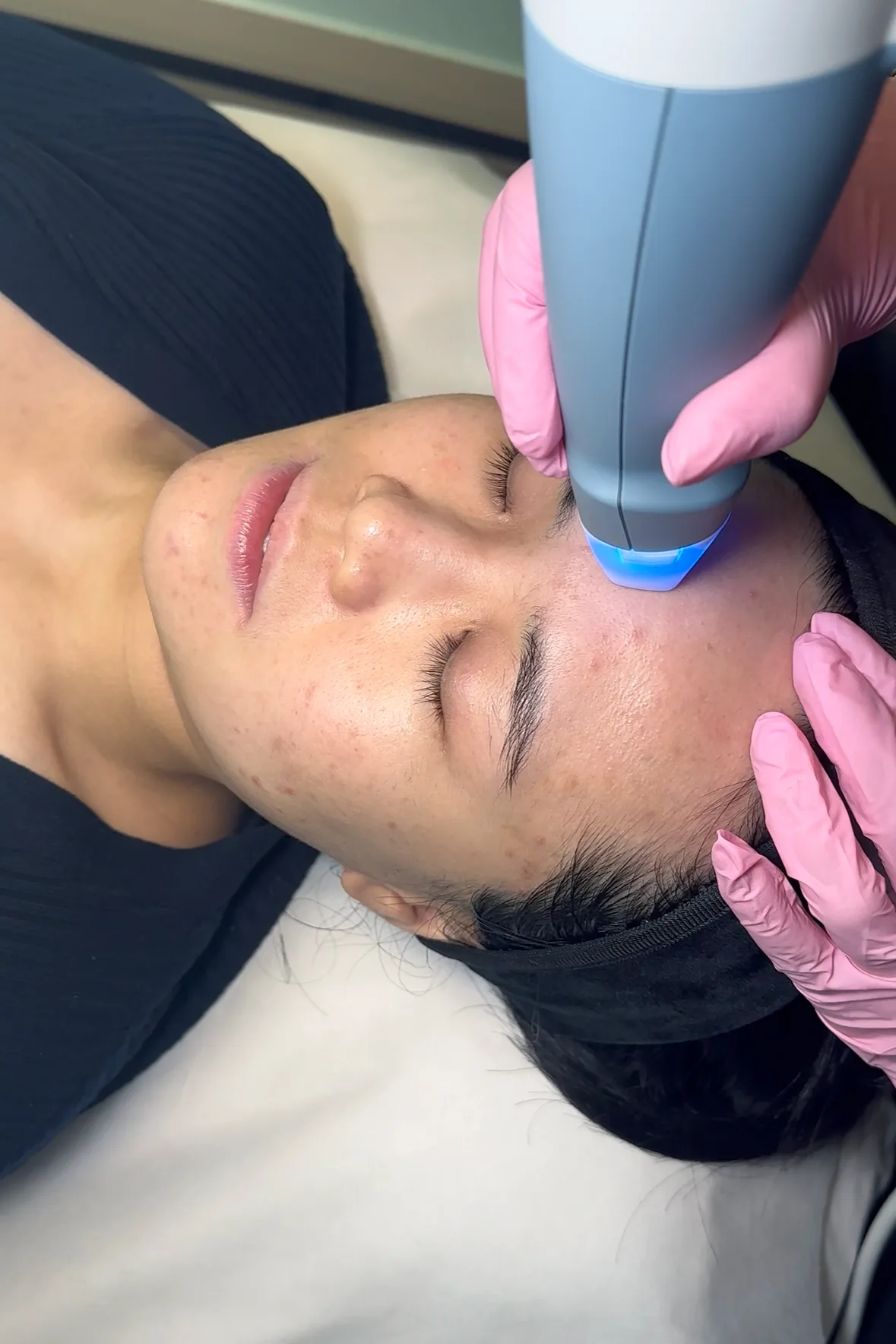 EXION Clear RF — treatment
