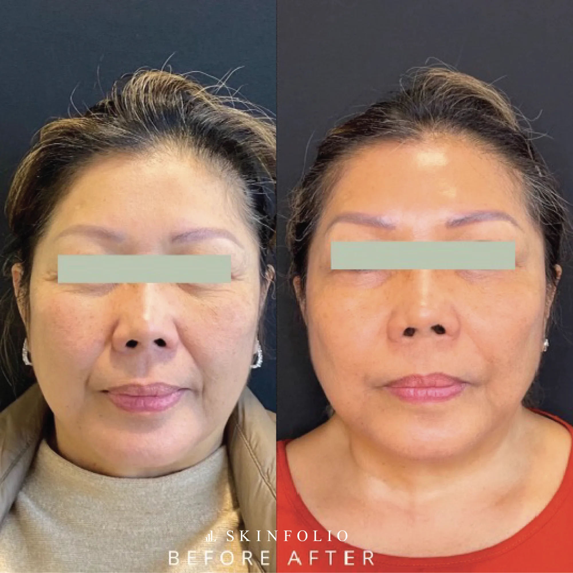 Before and after result