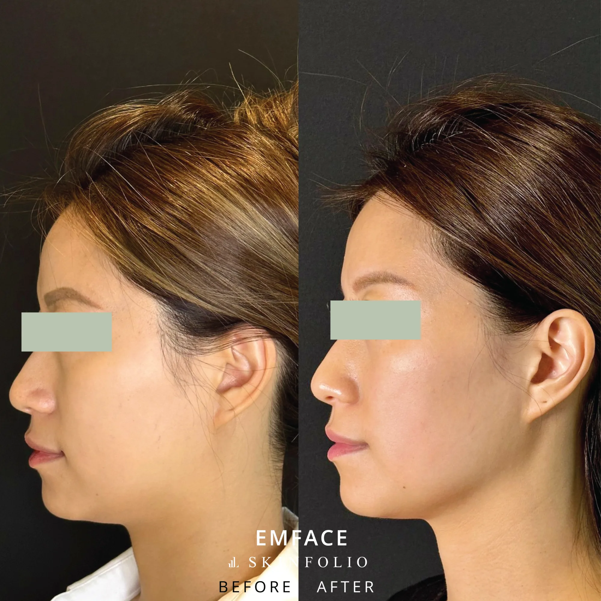 Before and after result
