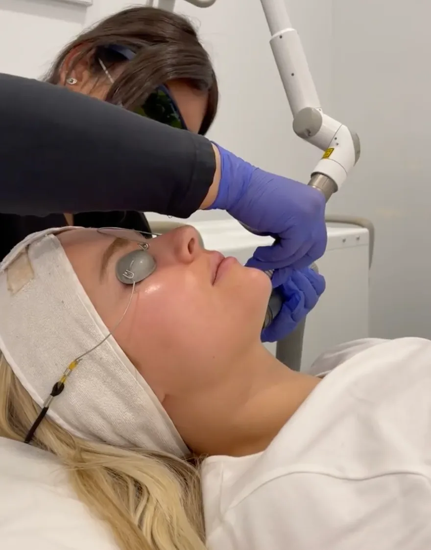 Weekend Peel — treatment