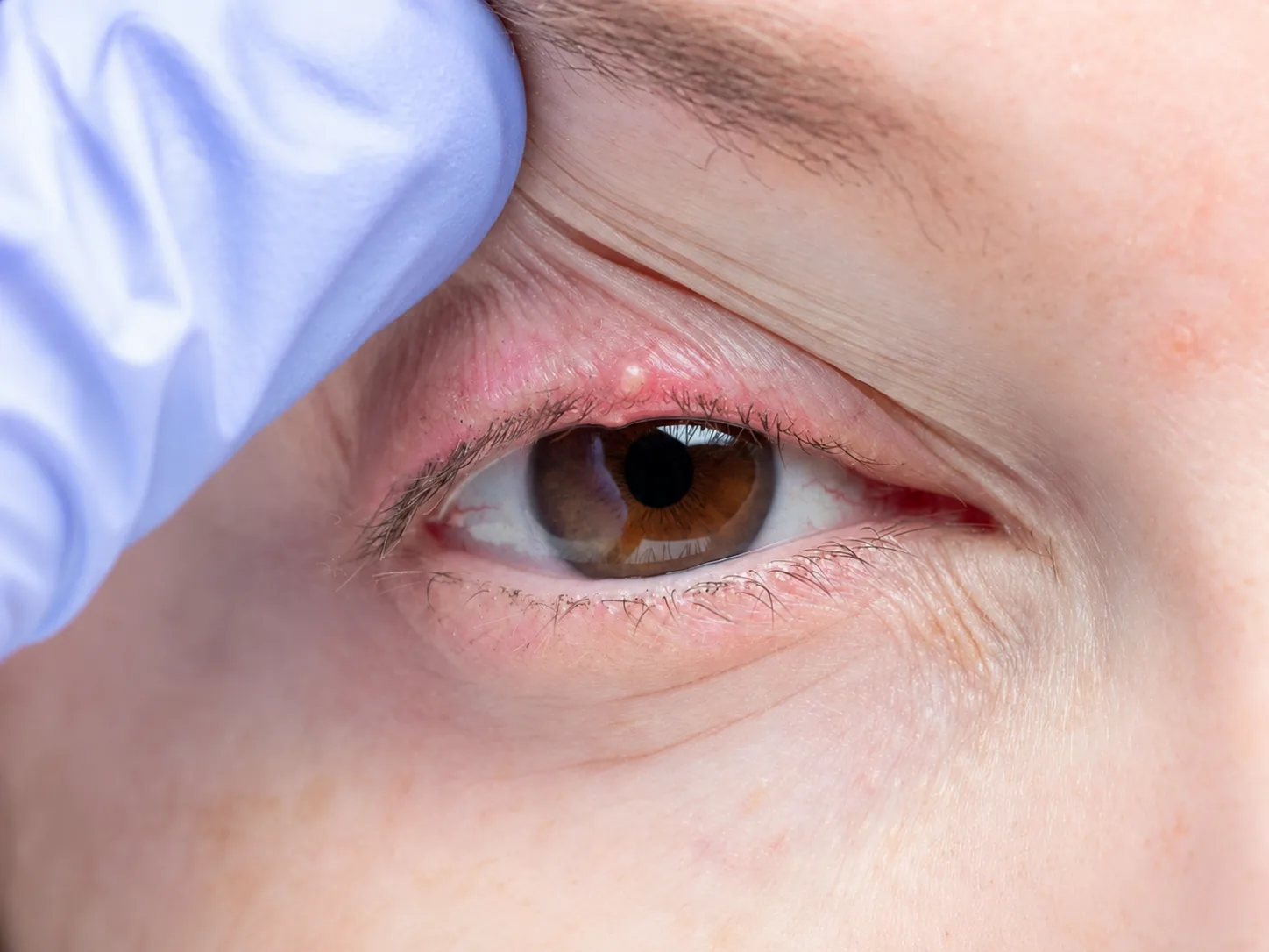 Meibomian Gland Dysfunction
