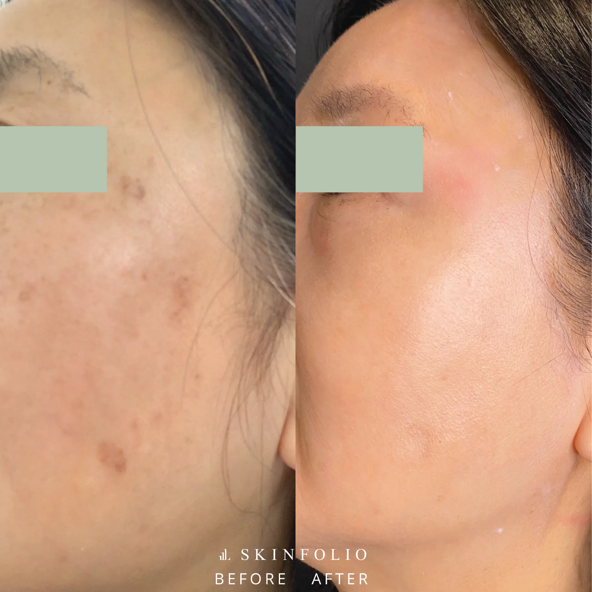 Before and after result