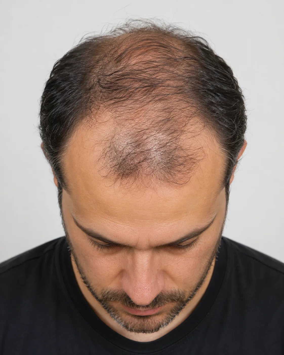 Androgenetic alopecia