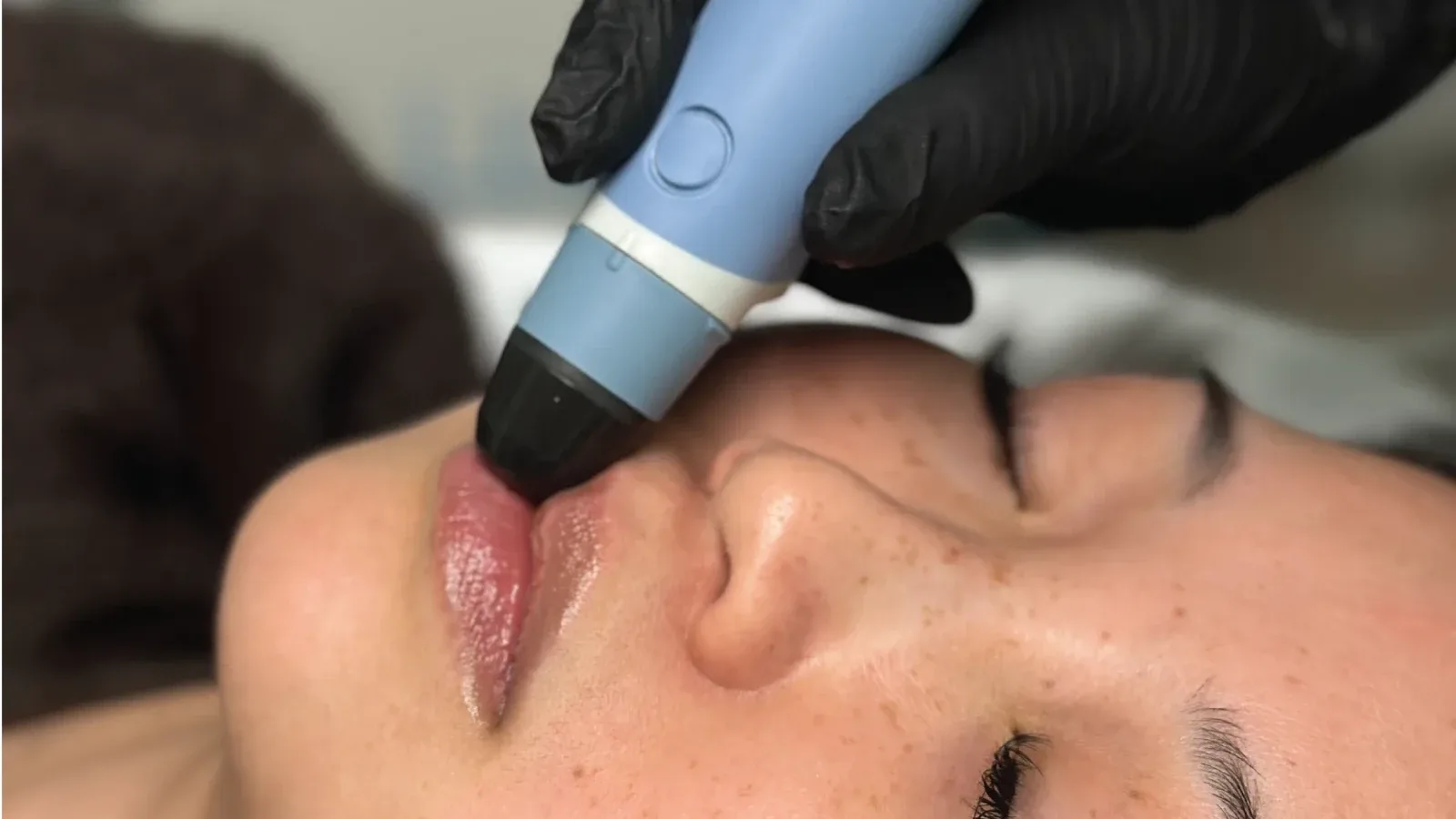 RF Collagen Stimulation — treatment