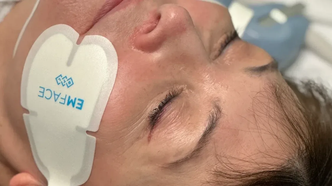 EMFACE Treatment: Complete Guide for Patients