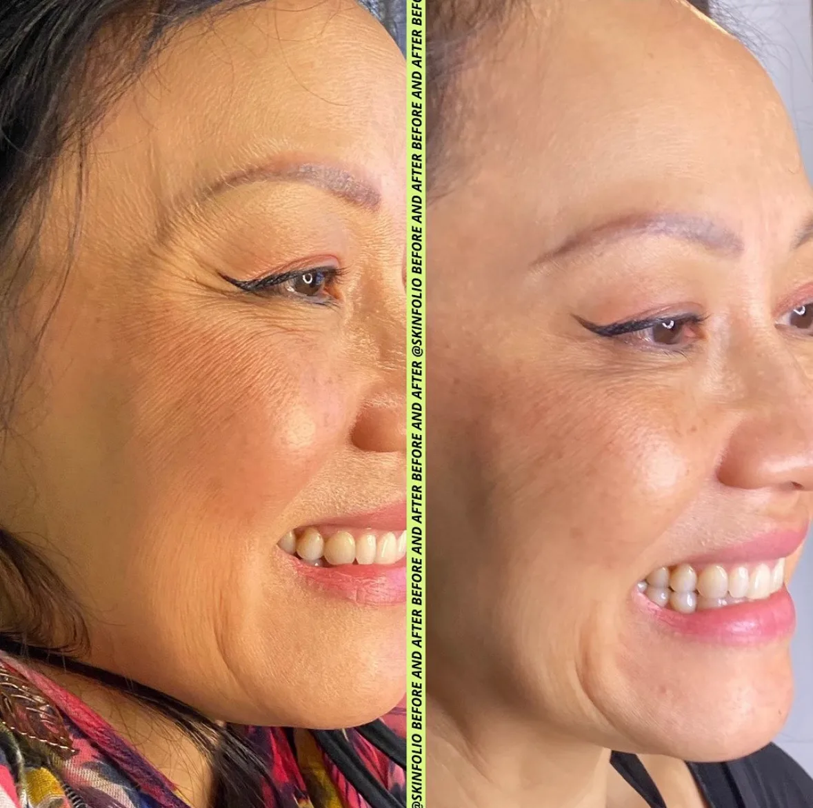 Before and after result