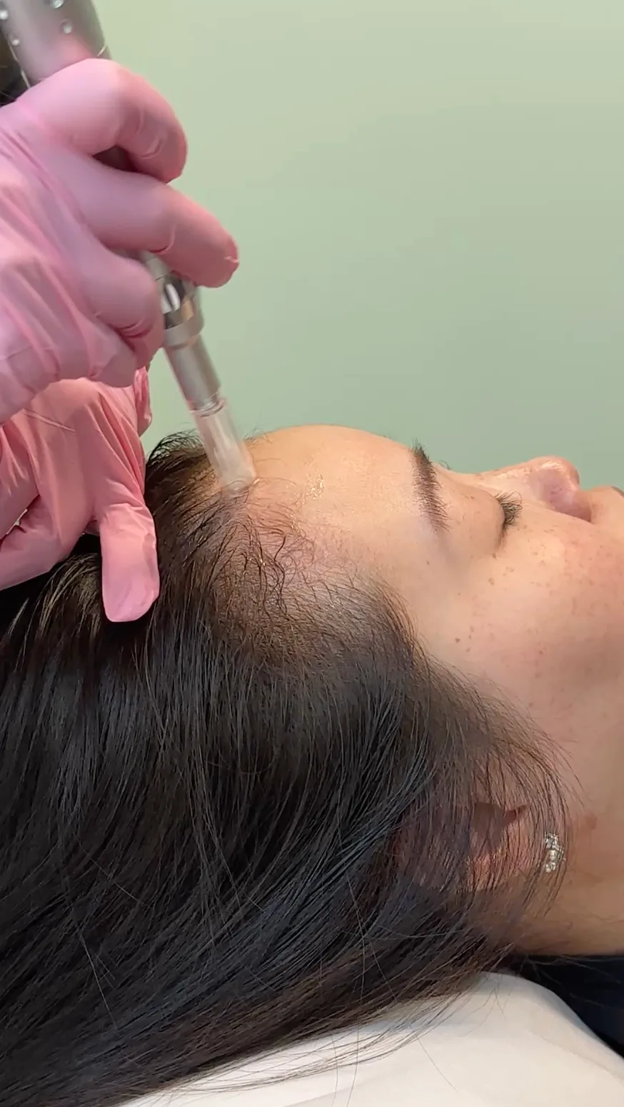 Hair Microneedling — treatment